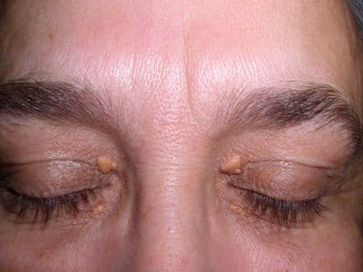 Xantelasma: https://commons.wikimedia.org/wiki/File:Xanthelasma.jpg