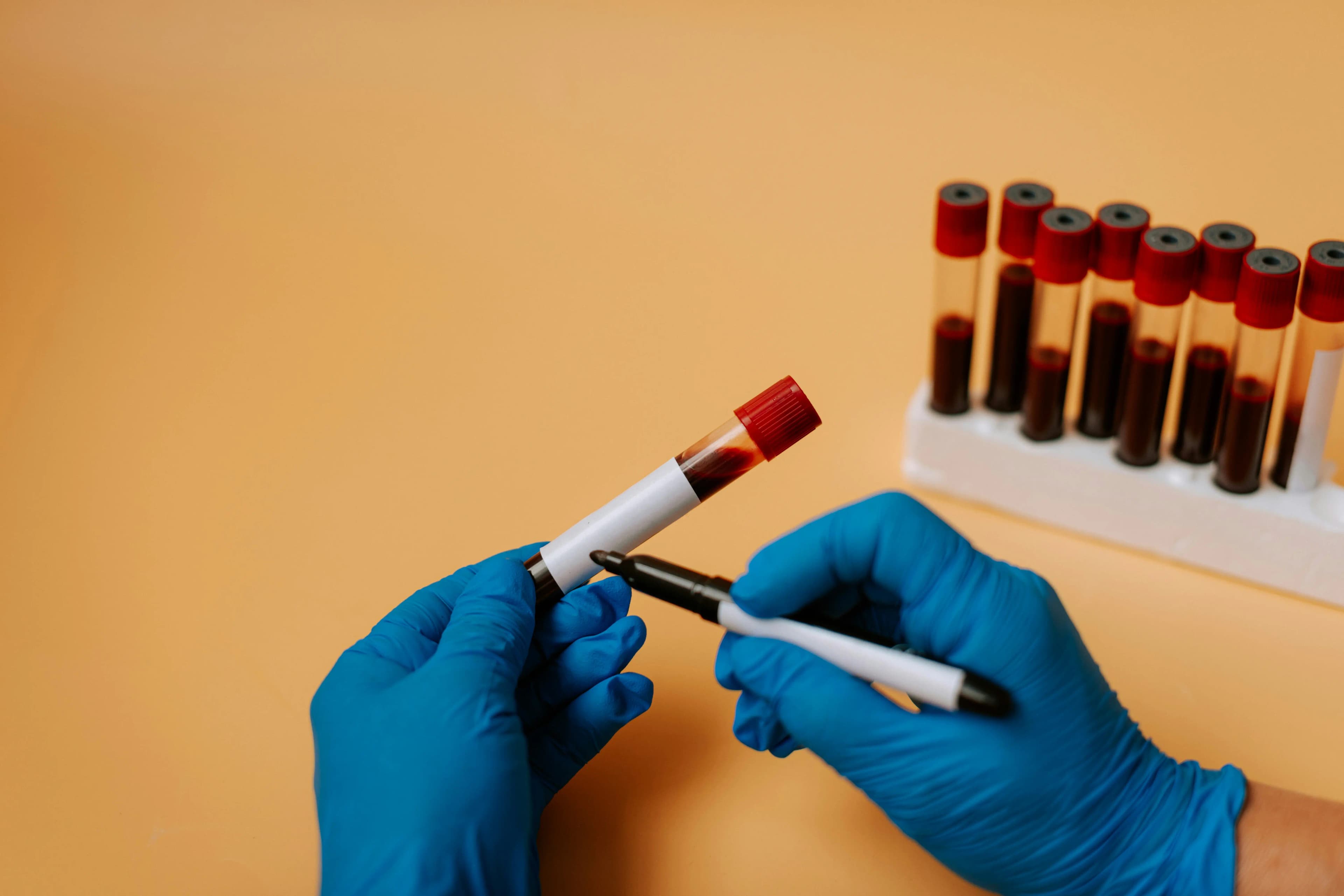 Blodprov för kolesterol – komplett lipidprofil